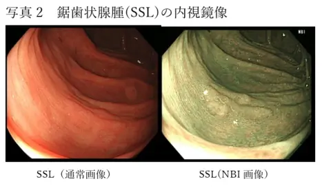大腸癌・大腸ポリープ | 一志胃腸科クリニック 江戸川区